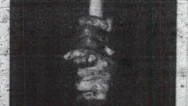 Skip Alexander asked doctors to fuse his hands so he could grip a golf club.